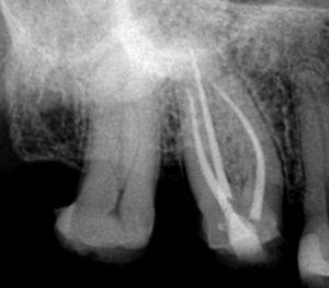 XP-3D Shaper - Next Generation Endodontic Instrumentation